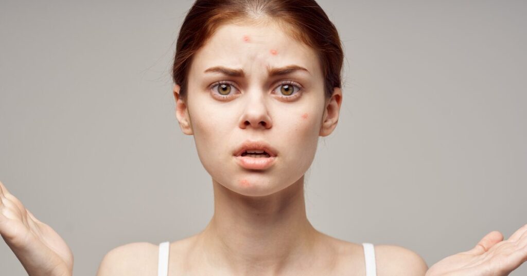 A Girl Having Acne On Her Face