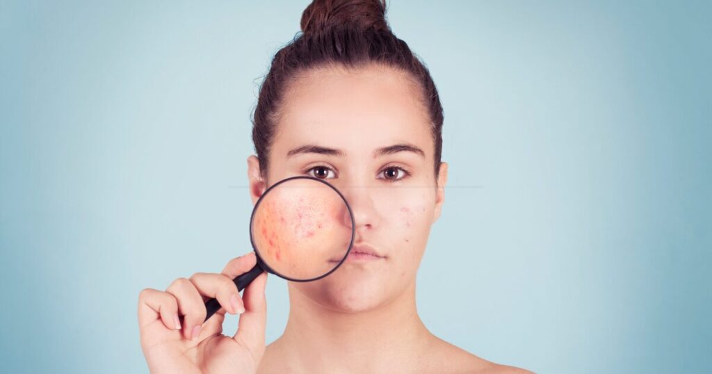 A Woman With Acne on Her Face