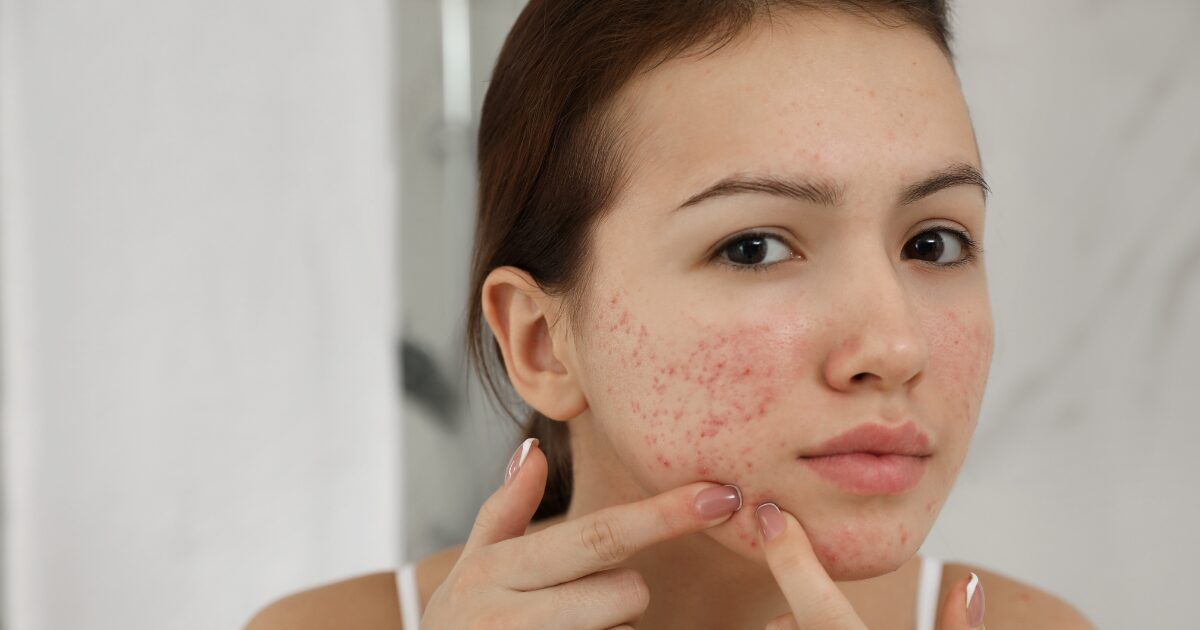 Does Adderall cause acne?