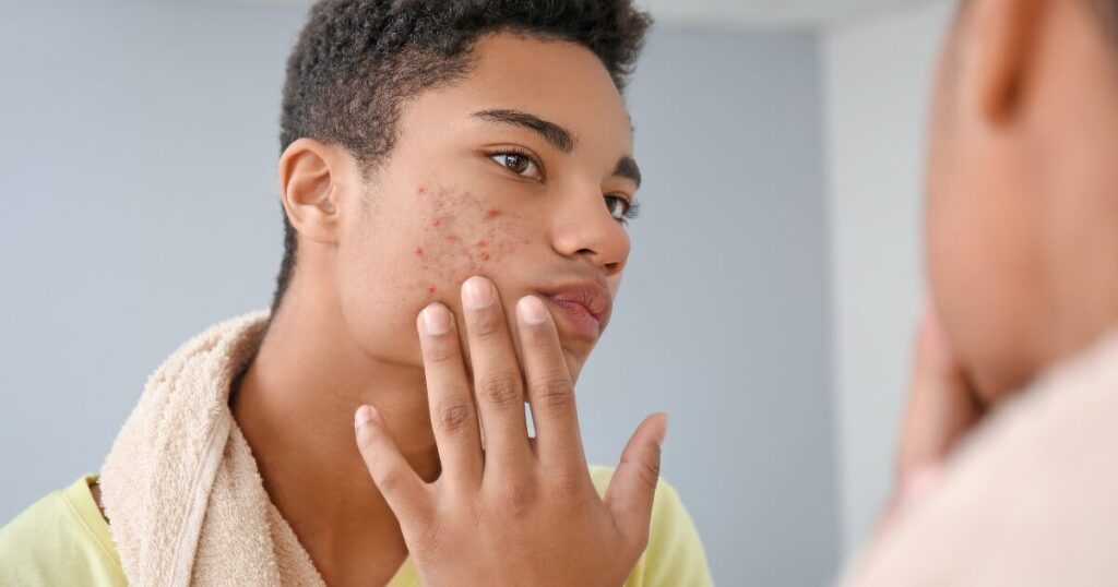 A Man Facing Acne Problem Due to Adderall Medication